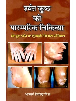 श्वेत कुष्ठ की पारम्परिक चिकित्सा- Traditional Medicine For White Leprosy