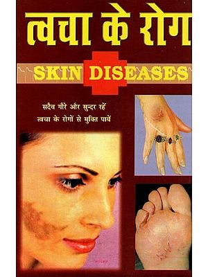 त्वचा के रोग- Skin Diseaes