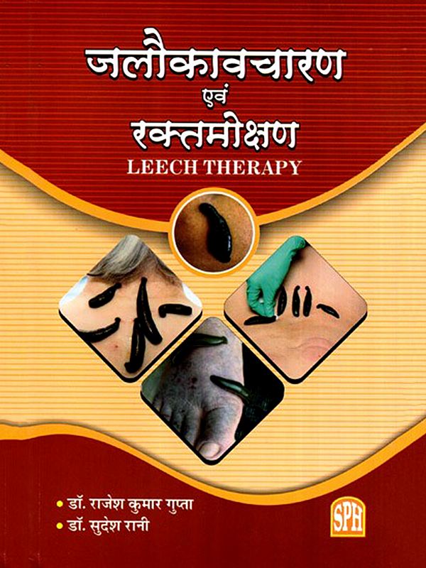 जलौकावचारण एवं रक्तमोक्षण: Jalaukavacharana and Raktamokshana- Leech Therapy