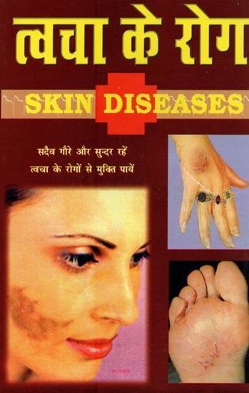 त्वचा के रोग- Skin Diseaes