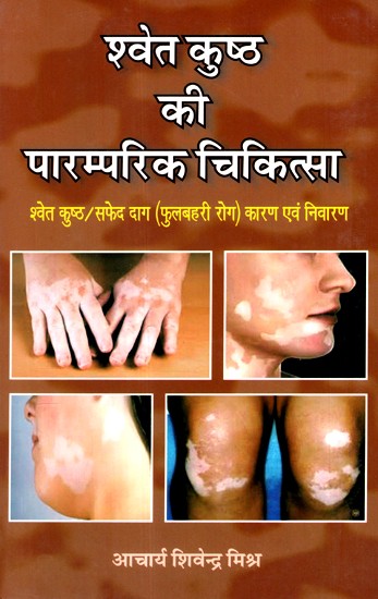 श्वेत कुष्ठ की पारम्परिक चिकित्सा- Traditional Medicine For White Leprosy
